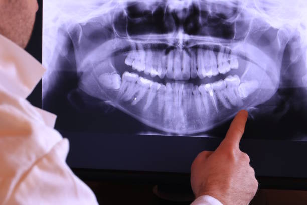 Best Emergency Wisdom Tooth Extraction in Lathrop, CA